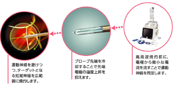 クーリーフ治療の仕組み