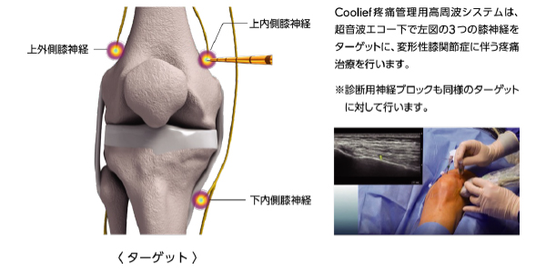 クーリーフ治療の仕組み